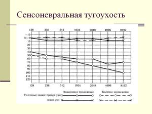 Левосторонняя сенсоневральная тугоухость 1-й степени