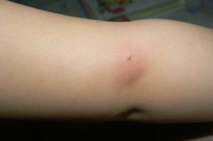 Болячка на руке похожая на укус комара