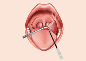 Как вылечить ринотонзиллофарингит