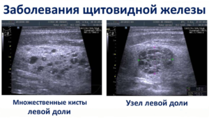 Кистозное расширение железы при эктопии