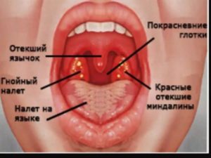 Можно ли купаться сразу после температуры и боли в горле