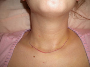 Массаж лица после удаления щитовидной железы