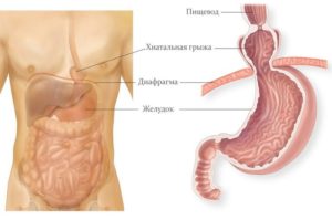 Исчезла грыжа пищевода