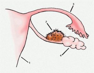 Киста яичника не походит