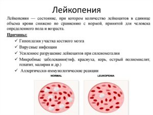 Лейкопения