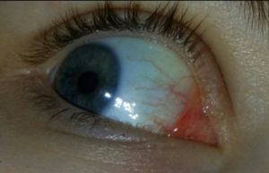 Боль в области внутреннего уголка глаза
