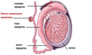 Киста семенного канатика