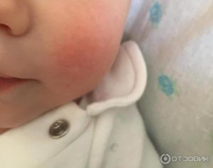 Красные шершавые щечки у ребенка 10-ти месяцев