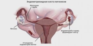 Киста яичника и тонкий эндометрий при планировании беременности