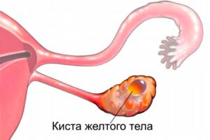 Киста желтого тела