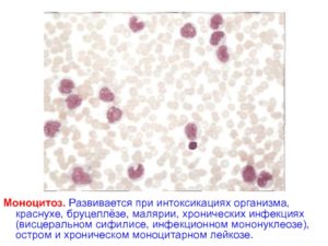 Лейкопения и моноцитоз после лечения описторхоза