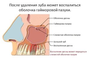 Кровь с гноем из пазухи после лечения канала верхнего 7 зуба