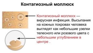 Контагиозный моллюск, плохие анализы крови и мочи