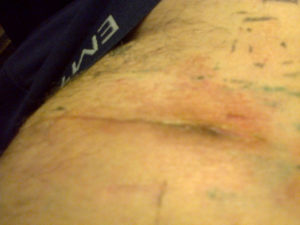 Келоидный рубец после операции паховый грыжи