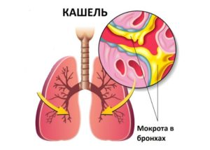 Бронхит с гнойной мокротой после орви