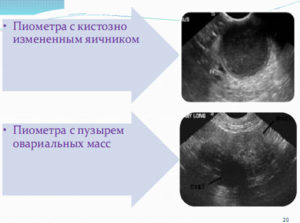 Кистозная дегенерация правого яичника