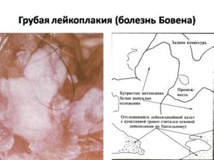 Лейкоплакия вульвы по гистологии, какие причины