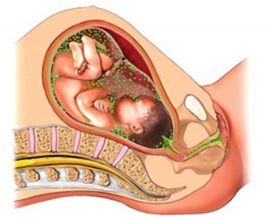 Хламидиоз во время беременности