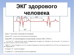 Как прочитать кардиограмму ЭКГ