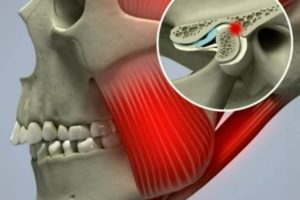Боль в месте соединения челюстей
