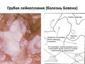 Лейкоплакия вульвы. Вопрсы лечения