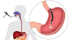 Колоноскопия при язве 12 перстной кишки