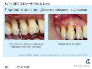 Больно ли измерять глубину пародонтальных карманов?