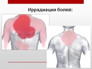 Иррадиация боли