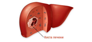 Киста печени