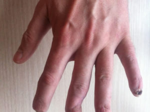 Кривой палец после травмы