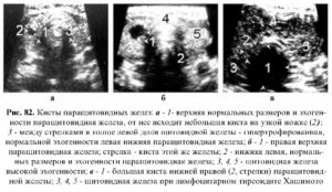 Кистозное расширение железы при эктопии