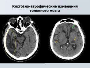 Кистозно атрофические изменения