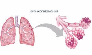 Бронхопневмония