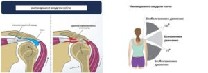 Импинджмент синдром левого плечевого сустава