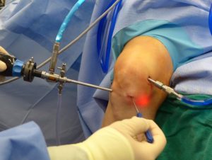 Боли после артроскопии коленного сустава