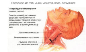 Боль в Правой стороне шеи горла и головы