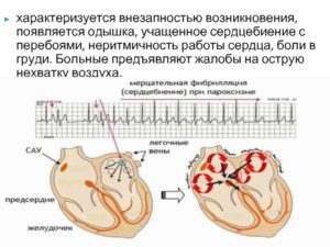 Боли в сердце и учащенное сердцебиение