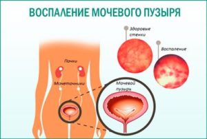 Кровь в моче после полового акта