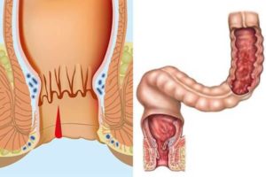 Лечение и диета при анальной трещине