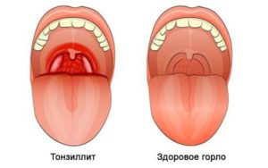 Красное горло и кашель у грудничка