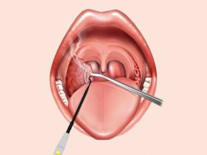 Болит горло, хронический тонзиллит и гайморит