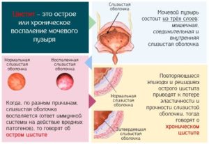 Кантарис С6 хронический цистит