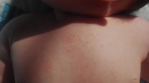 Мелкая сыпь на спине у двух детей и матери