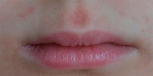 Красное пятно между верхней губой и носои б