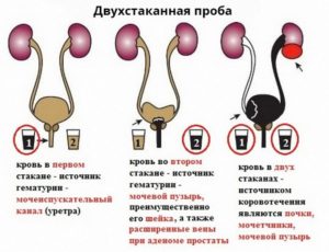 Кровь в моче после операции и простатит