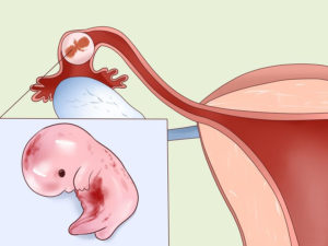 Как пережить внематочную беременность?