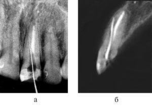 Перфорация корня зуба