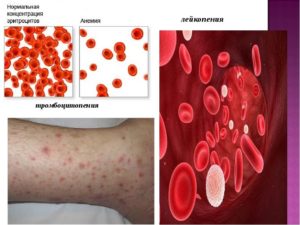 Лейкопения и анемия