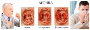 Кашель и сопли через неделю после гнойной ангины