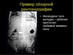 Инородное тело проглотил ребенок